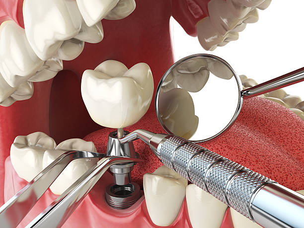 Best Urgent Care for Lost Fillings or Crowns in Omao, HI